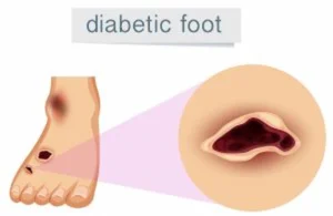 Diabetic Foot