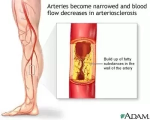 Arterial Diseases
