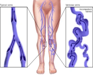 Varicose Veins Treatment in Singapore